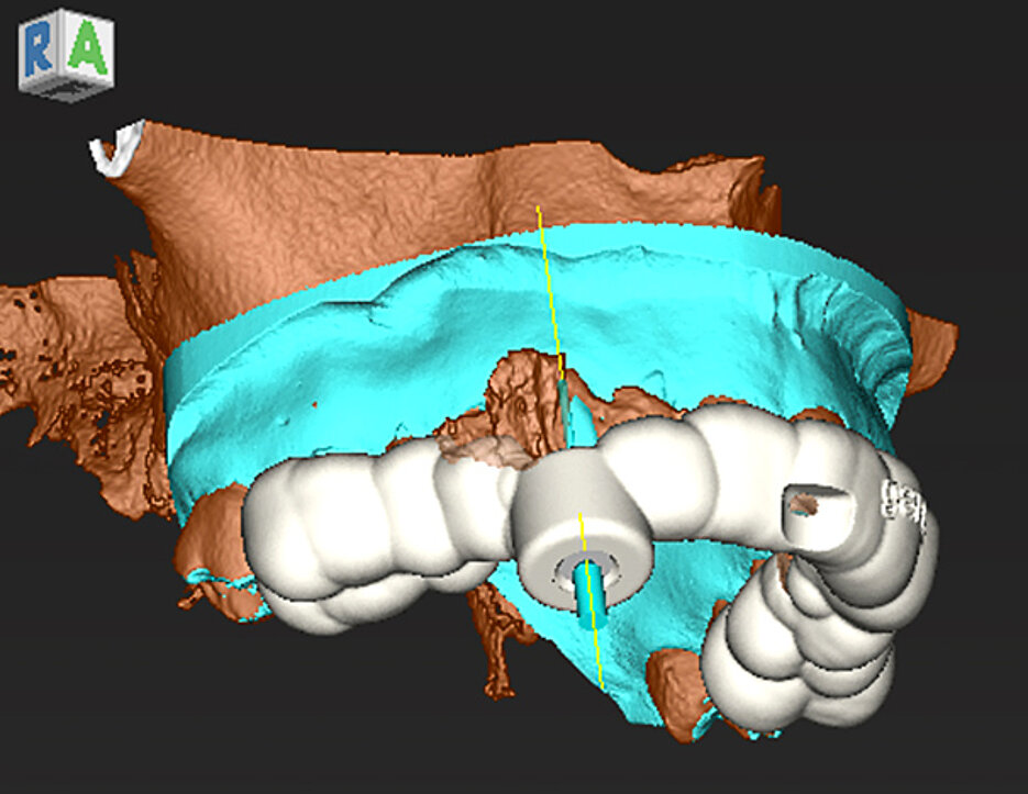 Einsatz von Guided Endodontics: virtuell geplante Bohrschablone nach Übereinanderlagerung der Datensätze der dreidimensionalen Röntgenschichtaufnahme und des Intraoralscans. (Bild: Zahnunfallzentrum)