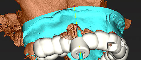 Einsatz von Guided Endodontics: virtuell geplante Bohrschablone nach Übereinanderlagerung der Datensätze der dreidimensionalen Röntgenschichtaufnahme und des Intraoralscans. (Bild: Zahnunfallzentrum)