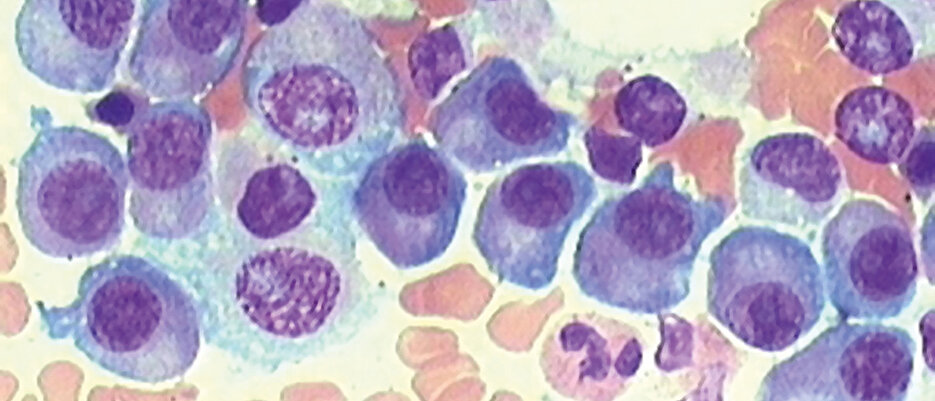 Bei gesunden Menschen sollte höchstens jede zwanzigste Zelle des Knochenmarks eine Plasmazelle sein. In diesem Knochenmarkausstrich eines Myelompatienten sind deutlich mehr violette Plasmazellen zu sehen. 