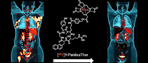 Die Bilder vor und nach der Behandlung zeigen den vielversprechenden Einsatz von Radioliganden in der Tumortherapie.
