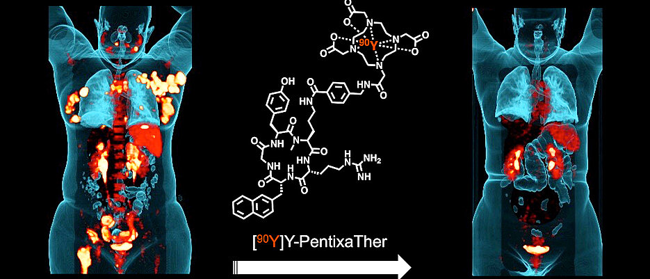 Die Bilder vor und nach der Behandlung zeigen den vielversprechenden Einsatz von Radioliganden in der Tumortherapie.