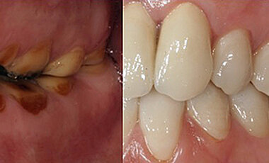Links Zahnschäden durch Zähneknirschen und eine Refluxerkrankung, rechts der Zustand nach einer prothetischen Behandlung. (Fotos: Marc Schmitter / Universitätsklinikum Würzburg)