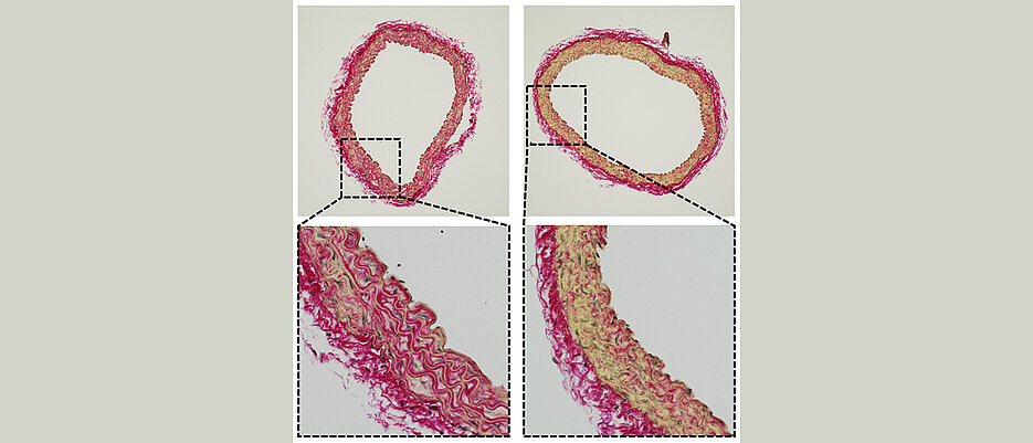 Darstellung von Kollagen (Fibrosierung, rot) links in der normalen, älteren Gefäßwand mit CEACAM1 und rechts in einer Gefäßwand, bei der CEACAM1 genetisch entfernt wurde.
