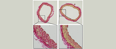 Darstellung von Kollagen (Fibrosierung, rot) links in der normalen, älteren Gefäßwand mit CEACAM1 und rechts in einer Gefäßwand, bei der CEACAM1 genetisch entfernt wurde.
