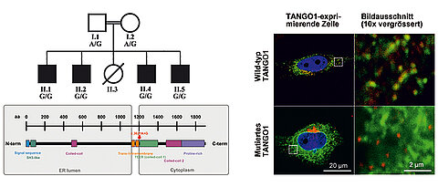 Der Stammbaum (oben links) zeigt die Familie mit vier betroffenen Söhnen (schwarze Quadrate), die sowohl vom Vater als auch von der Mutter, eine Mutation (G/G) in TANGO1 geerbt haben. Die Eltern sind blutsverwandt und zeigen jeweils eine defekte (G) und eine wild-typische (A) Genkopie. 
Das Diagramm (unten links) zeigt die Struktur des TANGO1-Proteins mit einem lumenalen und zytoplasmatischen Teil. Die Punktmutation (c.3621A>G) ist zwischen intramembrane und TEER-Domäne lokalisiert und trunkiert den zytoplasmatischen Teil. 
Die Immunfluoreszenzfärbung zeigt Zellen, die das wild-typische TANGO1-Protein (oben links) bzw. das mutierte TANGO1-Protein (unten links) exprimieren. Die grüne Fluoreszenz zeigt die Lokalisation von TANGO1, die rote Färbung (mit Antikörpern gegen das SEC16A-Protein) markiert die Stellen im endoplasmatischen Reticulum, die für den Export von Kollagenen verantwortlich sind. Der Zellkern ist (mit dem Farbstoff DAPI) blau gegengefärbt. Die vergrößerten Bildausschnitte repräsentieren die weiß umrandeten Areale im Zytoplasma. Das wild-typische TANGO1-Protein ist an den Exportstellen des ER lokalisiert, während das mutierte TANGO1 diese Co-lokalisation nicht zeigt.