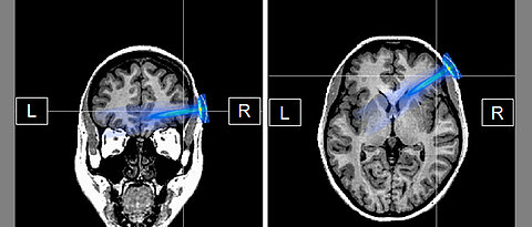 Die TUS-Technik besitzt das Potential auch mit niedrigen Energien sicher tiefer gelegene Gehirnareale anzusteuern. Der ellipsenförmige blaue Bereich zeigt ihren Einflussbereich in der aktuellen Studie, den rechten Präfrontalkortex. Dieser Bereich steht mit Gehirnregionen in Verbindung, die den für die Studie zentralen EEG-Parameter der mittfrontalen Theta-Frequenz hervorbringen, welche durch den Ultraschall erfolgreich beeinflusst werden konnte. 