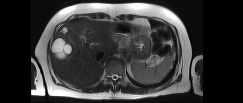 Querschnitt durch einen Oberkörper: Auf diesem MR-Bild sind links am Rand mehrere Zysten der Leber als weiße Blasen zu erkennen.