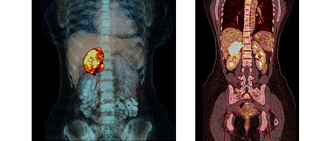 Adrenocortical carcinoma is a malignant degeneration of one of the hormone glands that sit in pairs as small caps on the kidney. The carcinoma is made visible in these images. 