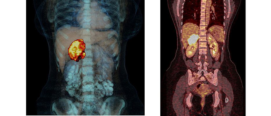 Adrenocortical carcinoma is a malignant degeneration of one of the hormone glands that sit in pairs as small caps on the kidney. The carcinoma is made visible in these images. 