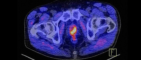 Das Prostatakarzinom steht im Zentrum des 6. Patienteninformationstags am Uniklinikum Würzburg. Das Bild zeigt, wie markant solch ein Karzinom im Computertomogramm als gelb-rotes Objekt dargestellt wird.