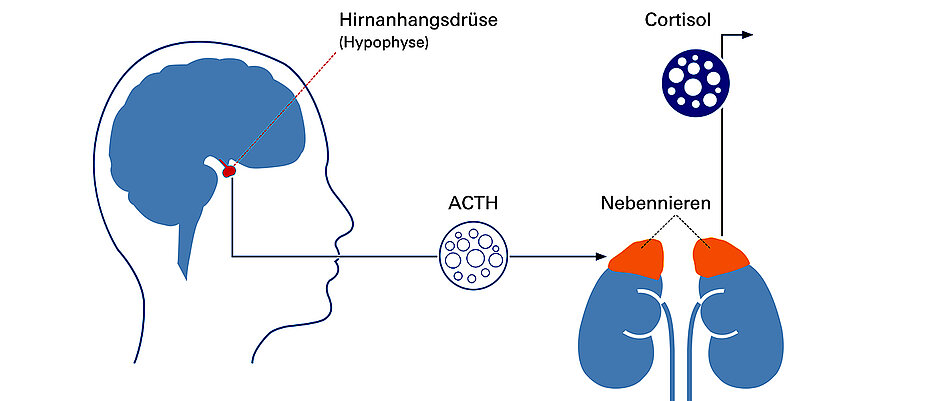 Das Cushing-Syndrom wird in den meisten Fällen durch gutartige Tumore der Hypophyse, eine erbsengroße Drüse unterhalb des Gehirns, ausgelöst. Durch den Tumor produziert diese sogenannte Hirnanhangsdrüse ungebremst das Hormon Adrenocorticotropin (ACTH), welches die Nebennieren antreibt, Cortisol auszuschütten.