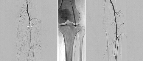 Die Angiographie-Aufnahme links dokumentiert einen kurzstreckigen Verschluss der Kniearterie vor der intravaskulären Lithotripsie. Bei dem Radiographie-Bild in der Mitte ist der Lithotripsie-Ballonkatheter während des Eingriffs zu sehen. Die Abschlussangiographie zeigt ein gutes technisches Resultat mit vollständig offener Kniearterie.