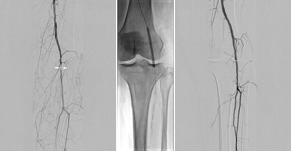 Die Angiographie-Aufnahme links dokumentiert einen kurzstreckigen Verschluss der Kniearterie vor der intravaskulären Lithotripsie. Bei dem Radiographie-Bild in der Mitte ist der Lithotripsie-Ballonkatheter während des Eingriffs zu sehen. Die Abschlussangiographie zeigt ein gutes technisches Resultat mit vollständig offener Kniearterie.