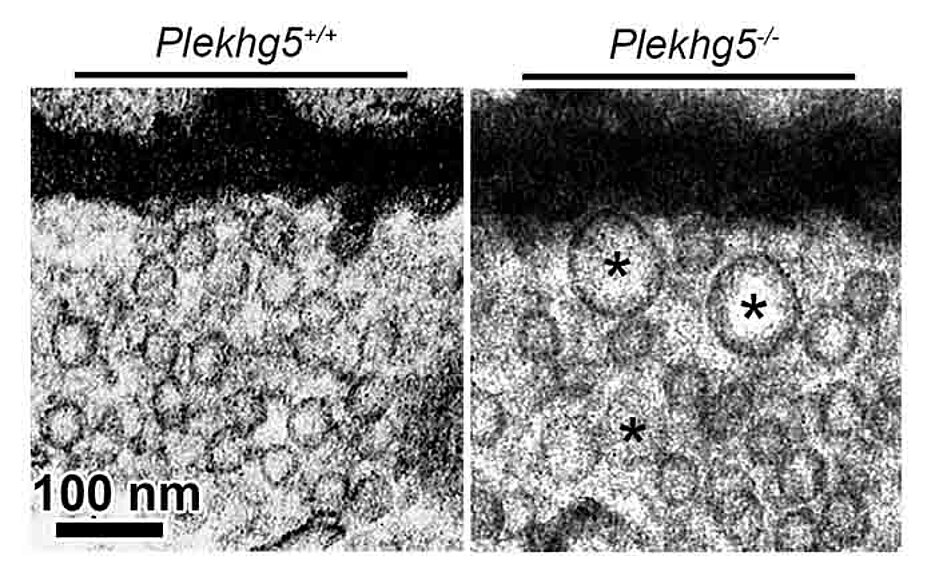 Electron microscope image of synaptic vesicles in the axon terminals of reference motor neurons (left) and Plekhg5-deficient motor neurons (right) at 100,000x magnification. Dysfunctional synaptic vesicles that are degraded in healthy individuals accumula