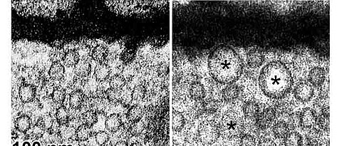 Electron microscope image of synaptic vesicles in the axon terminals of reference motor neurons (left) and Plekhg5-deficient motor neurons (right) at 100,000x magnification. Dysfunctional synaptic vesicles that are degraded in healthy individuals accumula