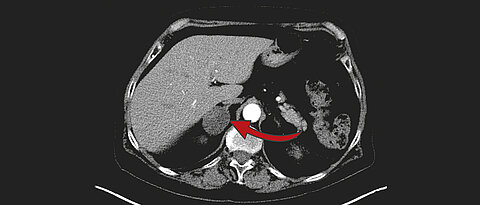 Das MRT zeigt einen drei Zentimeter großen Nebennierentumor auf der rechten Seite. 80 bis 90 Prozent dieser Tumore, die meist zufällig entdeckt werden, sind gutartig.