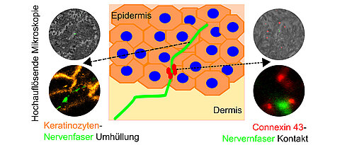 Mit Hilfe hochauflösender Mikroskopie konnte die Arbeitsgruppe von Nurcan Üçeyler am UKW zeigen, dass feine Nervenfasern in der obersten Hautschicht von speziellen Hautzellen, so genannten Keratinozyten, umhüllt sind und eine Signalübertragung über das Protein Connexin 43 stattfindet.