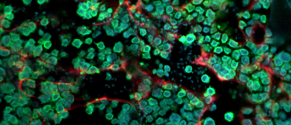 Multiple Myelomzellen im Knochenmark