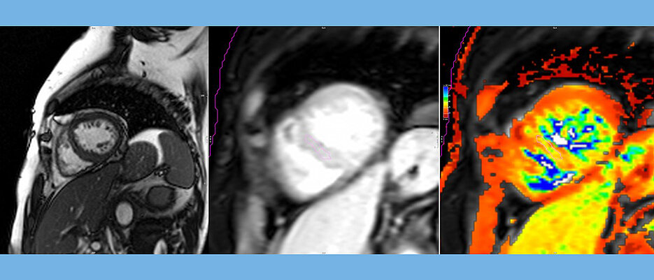 Kurzachsenschnitt durch das Herz. Links:  Mit dem klassischen Cine-MRT werden Struktur und Funktion des Herzens quantifiziert. Mitte: Beispiel einer Sequenz mit T2* Information. Eine Abnahme der in Millisekunden gemessenen T2* Zeit entspricht dabei einer Zunahme des Eisengehaltes. Rechts: Beim T2* Mapping wird durch Farbkodierung das Ausmaß der Veränderung von T2* über die Zeit visualisiert.
