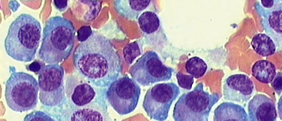 Im Knochenmark-Ausstrichpräparat sind die vielen, hier violetten Plasmazellen eines Myelom-Patienten zu erkennen. Bei Gesunden darf höchstens jede 20. Knochenmarkzelle eine Plasmazelle sein. (Foto: Uniklinikum Würzburg) 