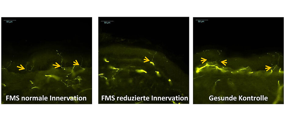 Mittels Stanzbiopsie gewonnene Hautproben von Patientinnen mit Fibromyalgie-Syndrom können eine normale Innervation aufweisen (links) oder die intraepidermale Nervenfaserdichte kann reduziert sein (Mitte). Im Vergleich rechts die Hautprobe einer gesunden Kontrollperson. Die Pfeile deuten auf intraepidermale Nervenfasern. 