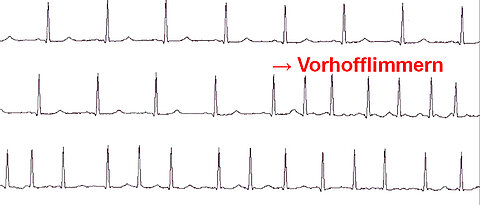 So zeigt sich Vorhofflimmern im Langzeit-Elektrokardiogramm (EKG).