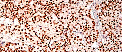 Immunhistochemische Färbung gegen TR4 in ACTH-produzierenden Hypophysentumoren. (Foto: AG Fassnacht)