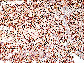 Immunhistochemische Färbung gegen TR4 in ACTH-produzierenden Hypophysentumoren. (Foto: AG Fassnacht)