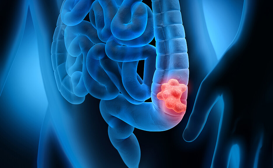 Tumours of the large intestine are the second and third most common type of tumour in men and women.