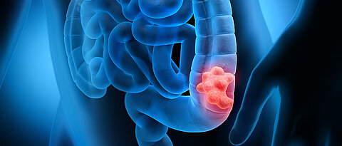 Tumours of the large intestine are the second and third most common type of tumour in men and women.