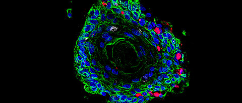 Image of patient-derived ectocervical stratified squamous organoids (Green) infected with Chlamydia trachomatis (red). 