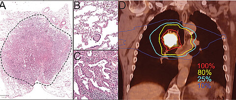 On the left, a stained adenocarcinoma from the lung. The enlarged section B shows healthy lung tissue, the enlarged section C an adenocarcinoma. Section D shows the PET-CT of a metabolically active central lung tumour, close to the trachea, heart and oesophagus. The irradiation dose distribution is shown in colour: Desired dose 100% in the tumour and 80% in the extended tumour area. 25% and 10% of the irradiation dose (turquoise and blue lines) in the healthy tissue for technical reasons.