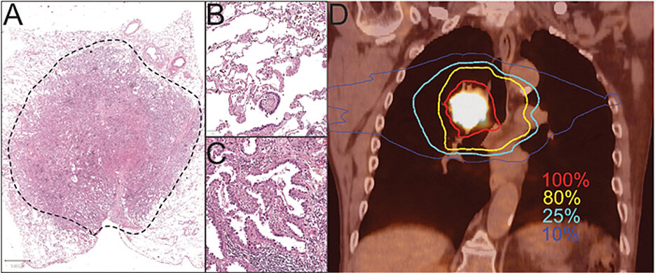 Links ein angefärbtes Adenokarzinom aus der Lunge. Der vergrößerte Ausschnitt B zeigt gesundes Lungengewebe, der vergrößerte Ausschnitt C ein Adenokarzinom. Unter D ist das PET-CT eines stoffwechselaktiven zentralen Lungentumors zu sehen, nahe an Luftröhre, Herz und Speiseröhre. Farbig dargestellt ist die Bestrahlungs-Dosisverteilung: Gewünschte Dosis 100% im Tumor und 80% im erweiterten Tumor-Bereich. 25% und 10% der Bestrahlungsdosis (türkise und blaue Linien) technisch bedingt im gesunden Gewebe.