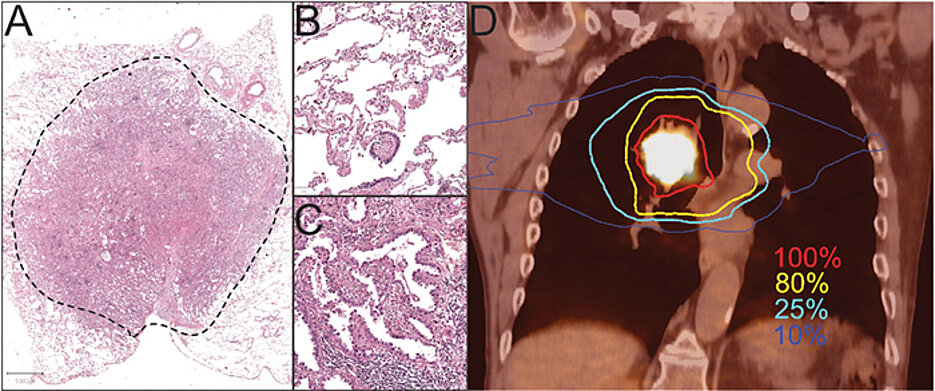 On the left, a stained adenocarcinoma from the lung. The enlarged section B shows healthy lung tissue, the enlarged section C an adenocarcinoma. Section D shows the PET-CT of a metabolically active central lung tumour, close to the trachea, heart and oesophagus. The irradiation dose distribution is shown in colour: Desired dose 100% in the tumour and 80% in the extended tumour area. 25% and 10% of the irradiation dose (turquoise and blue lines) in the healthy tissue for technical reasons.