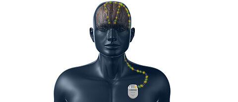 Beim neuen Neurostimulatorsystem wandern Impulse vom Schrittmacher zu den Elektroden im Gehirn und Messdaten von dort zurück.