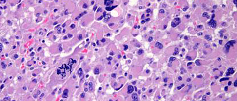 Gewebe eines Nebennierenkarzinom-Schnittes unter dem Mikroskop. Die blauen Bereiche sind die Zellkerne und das Zytoplasma ist lila eingefärbt. Bild: Uniklinikum Würzburg.