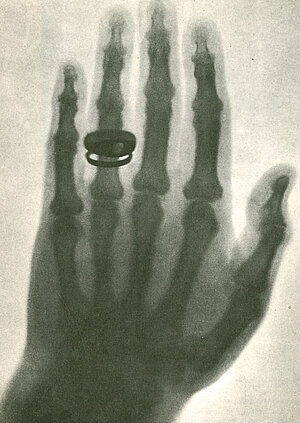 Radiograph of Albert Koelliker's hand. 