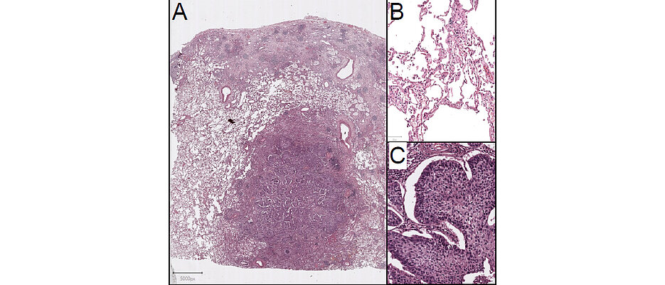 Das Bild zeigt eine Hematoxylin-Eosin-Färbung eines Plattenepitheltumors aus der Lunge, Hematoxylin färbt die Zellkerne blau/violett, Eosin das zelluläre Stützskelett rötlich (A).Die     Vergrösserung des Bildausschnittes B zeigt gesundes Lungengewebe, die Vergrösserung des Bildausschnittes C zeigt ein Plattenepithelkarzinom.