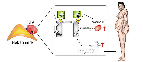 Bei einer Nebenniere mit eine gutartige Nebennierenadenom (links) ist der dem Protein-Kinase-A-Signalweg verändert (Mitte). Die Betroffenen entwickeln in der Folge die typischen Cushing-Syndrom-Merkmale.