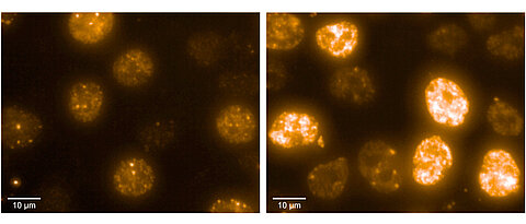 Neuroblastoma cells under the microscope. The staining represents DNA damage, the more intense, the more severe and dangerous the damage. Cells on the right have no RNA exosome and are therefore much more susceptible to such damage.