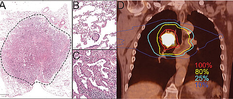 PM Diefenbacher Flentje On the left, a stained adenocarcinoma from the lung. The enlarged section B shows healthy lung tissue, the enlarged section C an adenocarcinoma. Section D shows the PET-CT of a metabolically active central lung tumour, close to the trachea, heart and oesophagus. The irradiation dose distribution is shown in colour: Desired dose 100% in the tumour and 80% in the extended tumour area. 25% and 10% of the irradiation dose (turquoise and blue lines) in the healthy tissue for technical reasons.